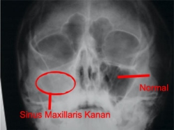 Obat Sinusitis Maksilaris